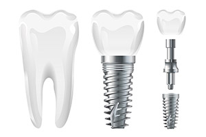 Gray-Dental_Implants-2