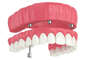 Gray-Dental_Implants-3