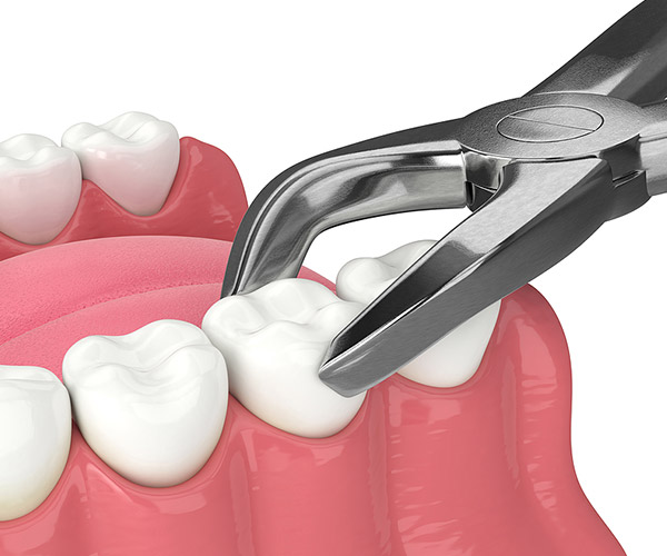 Gray-Extractions_Wisdom_Teeth-2
