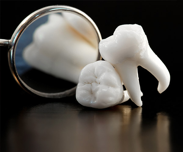 Gray-Extractions_Wisdom_Teeth-3