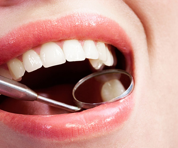 Gray-Fillings_Cleanings-2