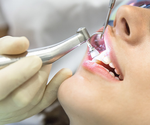 Gray-Fillings_Cleanings-3
