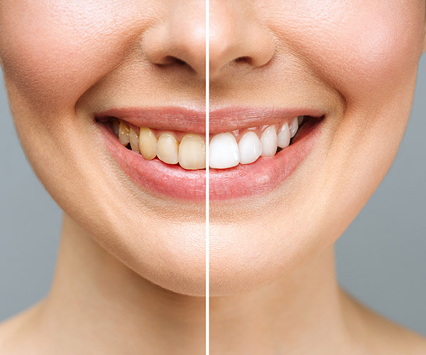 Gray-Teeth_Whitening-2